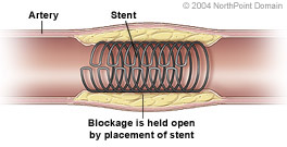 After angioplasty is complete, a stent may be placed inside the artery.