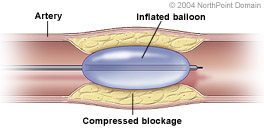 An angioplasty balloon catheter inside a coronary artery.