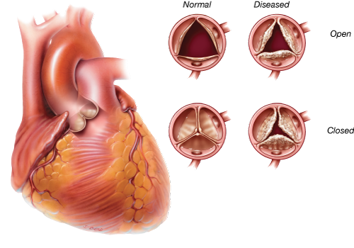 Calcification due to aging